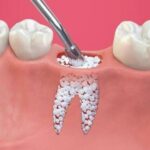 ENXERTO ósseo: alternativa técnica para viabilizar implantes dentários
